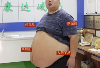 体重正常医生怎么还让你减肥？长春康达医院专家：小心中心性肥胖2.jpg